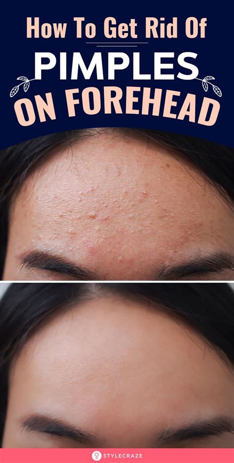 How To Get Rid Of Pimples On Forehead In 2020 Pimples On Forehead