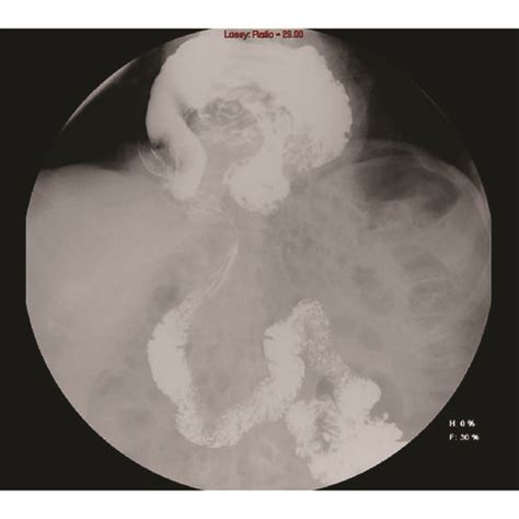 Ct Scan Showing Huge Hiatal Hernia And Upside Down Stomach Download