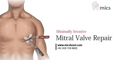 Minimally Invasive Mitral Valve Repair Mics Heart