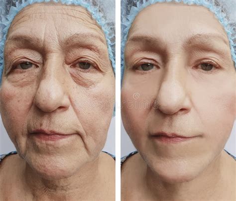 Face Of An Old Woman Wrinkles Results Treatment Medicine Before And