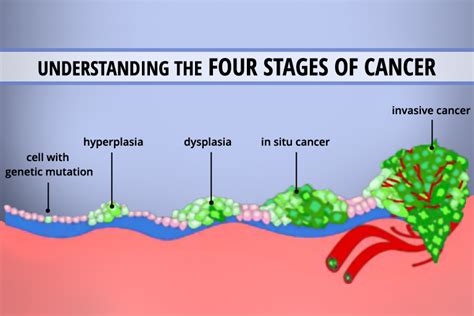 understanding the 4 stages of cancer