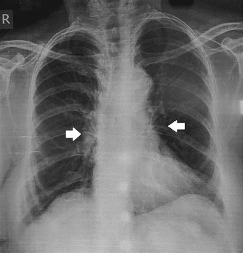 Follow Up Chest X Ray At 3 Months Of Therapy Showing Radiographic