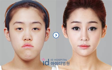 Id Hospital Korea It Is Miracle Two Jawdouble Jaw Surgery V Line