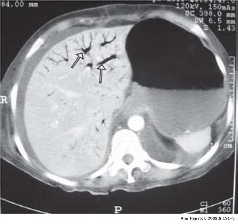 Portal Venous Gas Report Of Three Cases Annals Of Hepatology