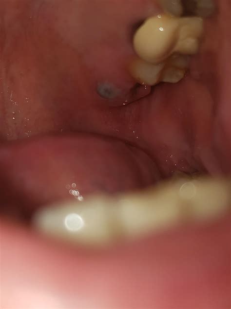 Had A Wisdom Tooth Extracted Yesterday And This Whitegray Bump Formed