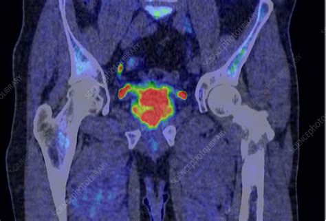 Prostate Cancer Ct Pet Scan Stock Image C Science Photo Library