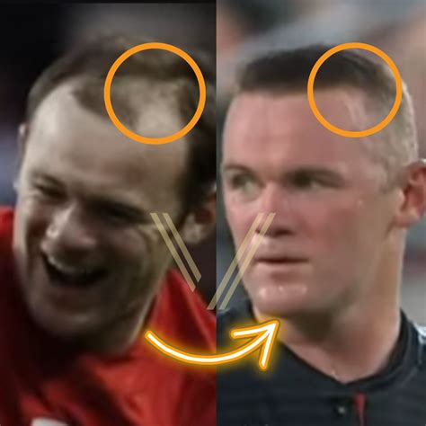 wayne rooney s hair transplant before and after transformation