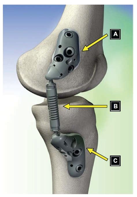 Figure 1 Components Of The Kinespring® Knee Implant System Moximed