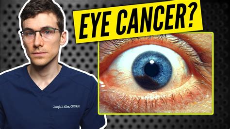 Eye Cancer Eye Freckle Vs Melanoma Of The Eye Youtube