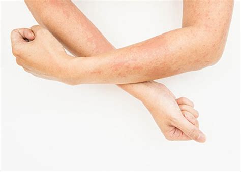 Spacieux Naissance Faire Attention à Rash On Legs And Arms Lumières