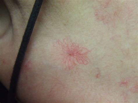 The virus persists in the liver in about 75% to 85% of those initially infected. Hepatitis, Gelbsucht / Gilb - André Seidenberg