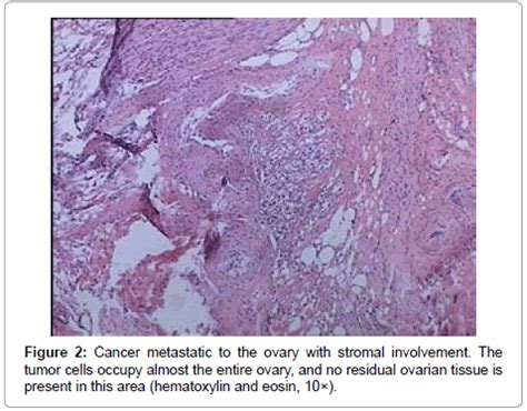 Local recurrence is usually found on a mammogram, during a physical exam by a health care provider or when you notice a change in or around the breast or underarm. Pelvic Recurrence of Breast Cancer Presenting as Ovarian ...
