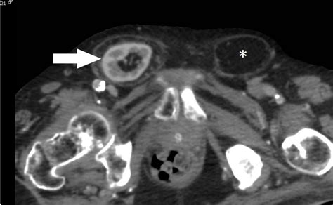 Inguinal Hernia Containing A Native Orthotopic Kidney Bmj Case Reports