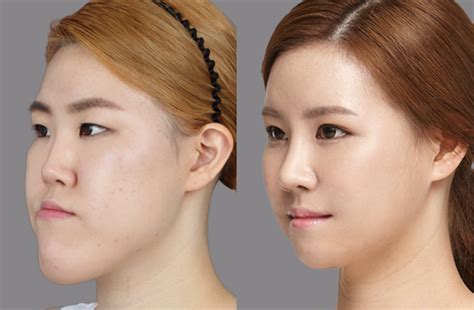Before And After Photos Korean Two Jaw Surgery 짱이뻐