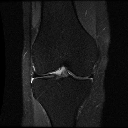 Normal MRI Knee Radiology Case Radiopaedia Org