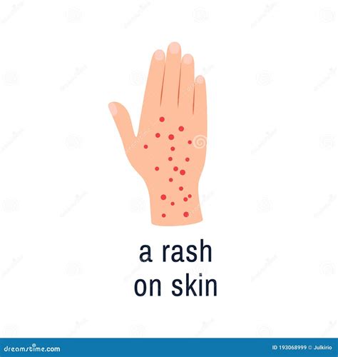 Skin Rash. Hives Or Urticaria. Vector Illustration | CartoonDealer.com