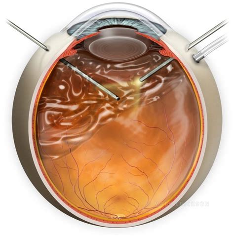 Pars Plana Vitrectomy Ppv Vitreoretinal Eye Surgery Illustration