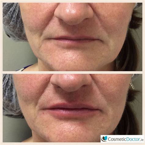 Before And After Lip Augmentation Cosmetic Doctor Dublin Cosmetic