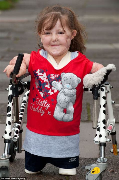 Girl 7 Who Lost Her Legs To Meningitis Can Walk For First Time After 76 Operations And Now