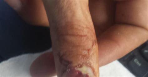 Thumb Injury Album On Imgur