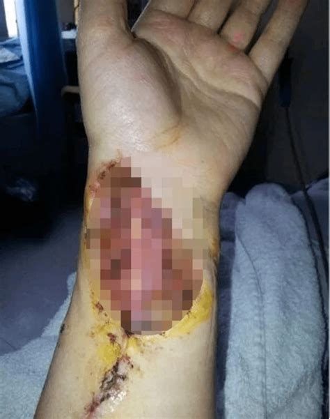 But such pathologic conditions as benign tumours, ulcer of the stomach, gastritis and stomach polyps have. 'When The Doctor Told Me I Had Mouth Cancer All I Heard ...