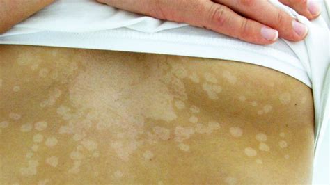 Tinea Versicolor Causes Symptoms And Treatment