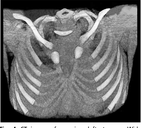 Figure 4 From Thoracic Defects Cleft Sternum And Poland Syndrome