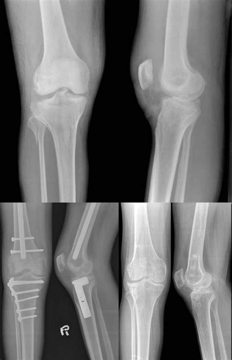 Tibial Plateau Fractures Radiology Notes