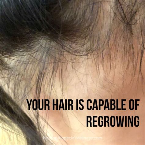 Pin On Alopecia Hair Growth