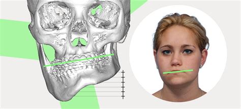 Asymmetrical Jaw And Chin Causes And How To Fix It Naturally Ach