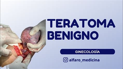 Teratoma Benigno De Ovario Quiste Dermoide YouTube