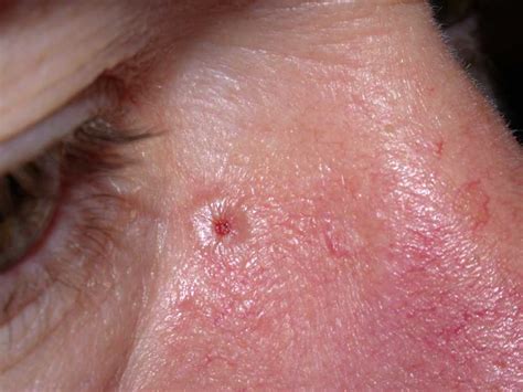 Basal Cell Carcinoma Article Statpearls
