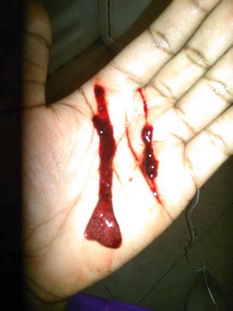 It's worth knowing that spotting can also be a symptom of implantation bleeding in early pregnancy, while some women spot around their ovulation day (this can make it even harder to tell if you've had an anovulatory cycle). GRAPHIC Picture is This A Miscarriage Or a Normal Period ...