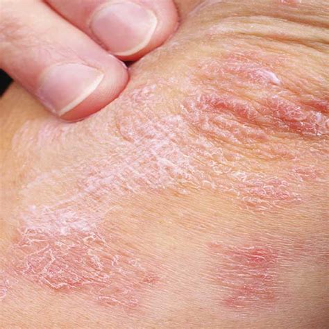 Dry Patches On Skin Not Itchy Or Red Atopic Dermatitis Symptoms