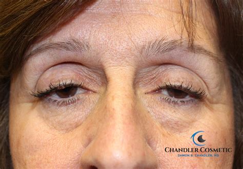 Droopy Eyelid Surgery In Philadelphia Dr Chandler