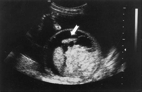 Figure 1 From Hydrops Fetalis Secondary To Parvovirus B19 Infections Semantic Scholar