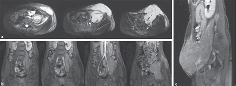 Figure 1 From Primary Anaplastic Large Cell Lymphoma Of The Psoas