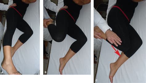 Extra Articular Snapping Hip Syndromes Musculoskeletal Key