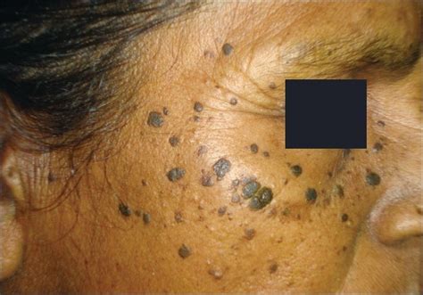 SKIN DISEASE TYPES Seborrheic Keratosis Skin Disease Type