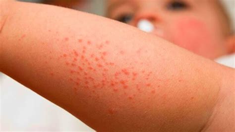 What Does Sun Allergy Rash Look Like See These Pictures