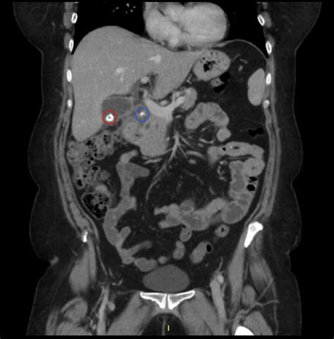 Fragmenting and removing a complex biliary stone under direct visualization. Abdominal CT scan demonstrating the presence of 2 biliary ...