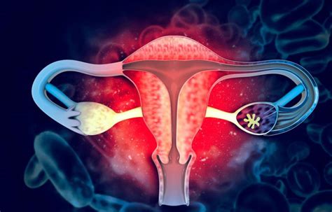 Fibromas uterinos causas síntomas y tratamiento Diario Libre