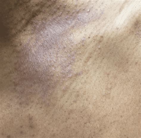 What Does Eczema Look Like On Black Peoples Skin Instyle