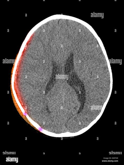 Ct Scan Showing Scalp Hematoma Subdural Hematoma And Skull Fracture In