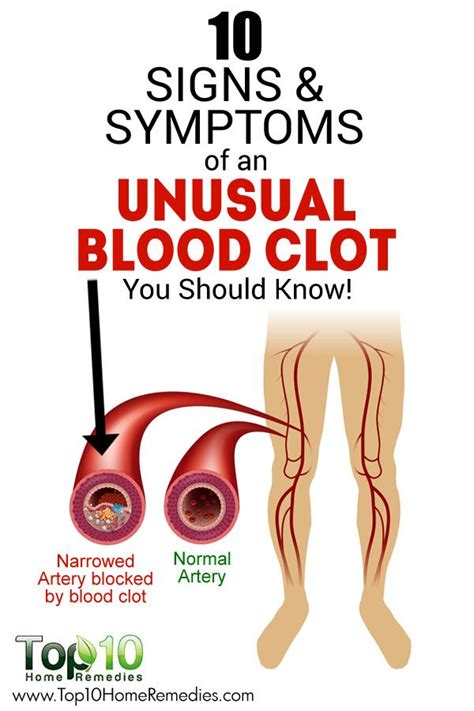 Symptoms Of Blood Clot In Leg Deep Vein Thrombosis Dvt Symptoms