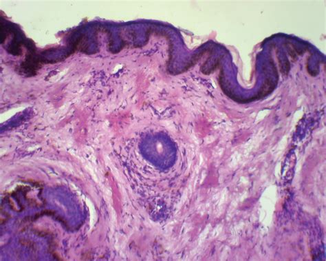 Pathology Outlines Pseudoxanthoma Elasticum
