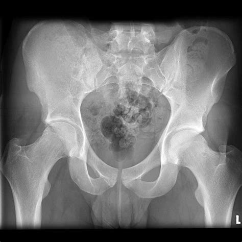 Ewing Sarcoma Pelvis Radiology Case Hip