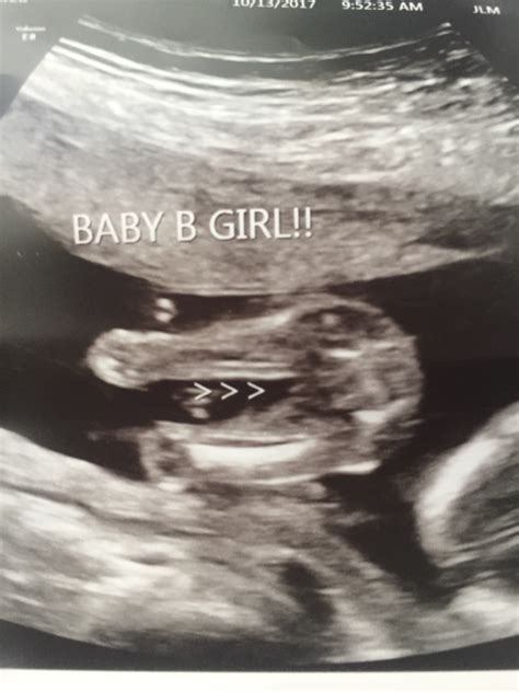 Dec 20, 2020 · but developments in noninvasive prenatal tests (nipts) mean you can be let in on this little secret with a simple blood test — even if gender determination isn't their main purpose — as early as 10. 16 week gender ultrasound - Glow Community