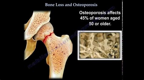 Osteoporosis Everything You Need To Know Dr Nabil Ebraheim Youtube