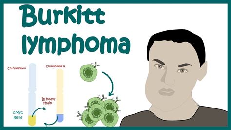 Burkitts Lymphoma Aggressive B Cell Non Hodgkins Lymphoma Cellular Basis Of Burkitts